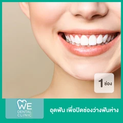 อุดฟัน เพื่อปิดช่องว่างฟันห่าง 1 ช่อง