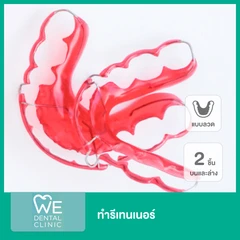 ทำรีเทนเนอร์ แบบลวด 2 ชิ้น ฟันบนและล่าง