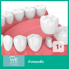 ทำครอบฟัน 1 ซี่