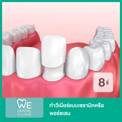 ทำวีเนียร์แบบเซรามิกหรือพอร์ซเลน 8 ซี่