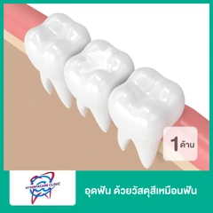 อุดฟัน ด้วยวัสดุสีเหมือนฟัน 1 ด้าน