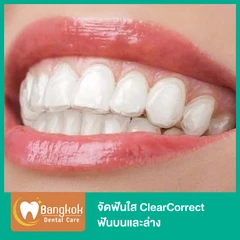 จัดฟันใส ClearCorrect ฟันบนและล่าง