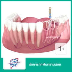 รักษารากฟันกรามน้อย 1 ซี่