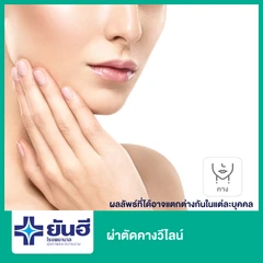 ผ่าตัดคางวีไลน์