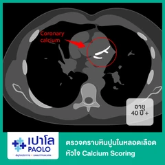 ตรวจคราบหินปูนในหลอดเลือดหัวใจ Calcium Scoring สำหรับผู้ที่อายุ 40 ปีขึ้นไป