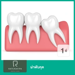 ผ่าฟันคุด 1 ซี่