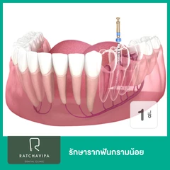 รักษารากฟันกรามน้อย 1 ซี่