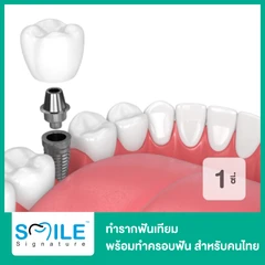 ทำรากฟันเทียม ยี่ห้อ P-I พร้อมทำครอบฟัน สำหรับฟัน 1 ซี่ สำหรับคนไทย