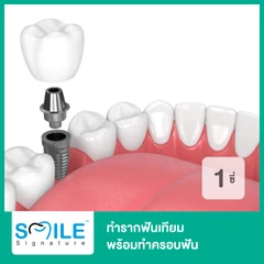 ทำรากฟันเทียม ยี่ห้อ Straumann SLA พร้อมทำครอบฟัน สำหรับฟัน 1 ซี่