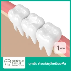 อุดฟัน 1 ด้าน ด้วยวัสดุสีเหมือนฟัน