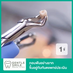 ถอนฟันอย่างยาก 1 ซี่ ขึ้นอยู่กับทันตแพทย์ประเมิน