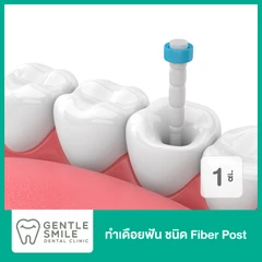 ทำเดือยฟัน ชนิด Fiber Post สำหรับฟัน 1 ซี่