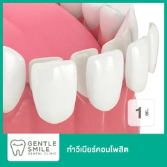 ทำวีเนียร์คอมโพสิต สำหรับฟัน 1 ซี่