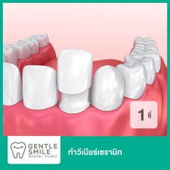 ทำวีเนียร์เซรามิก สำหรับฟัน 1 ซี่