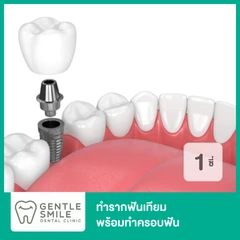 ทำรากฟันเทียม ยี่ห้อ Bego พร้อมทำครอบฟัน สำหรับฟัน 1 ซี่