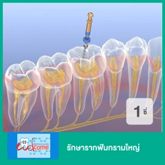 รักษารากฟันกรามใหญ่ 1 ซี่