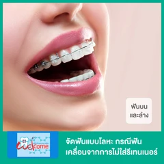 จัดฟันแบบโลหะ ฟันบนและล่าง กรณีฟันเคลื่อนจากการไม่ใส่รีเทนเนอร์