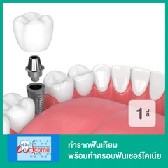 ทำรากฟันเทียม ยี่ห้อ Osstem พร้อมทำครอบฟันเซอร์โคเนีย สำหรับฟัน 1 ซี่