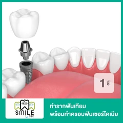 ทำรากฟันเทียม ยี่ห้อ Osstem พร้อมทำครอบฟันเซอร์โคเนีย สำหรับฟัน 1 ซี่