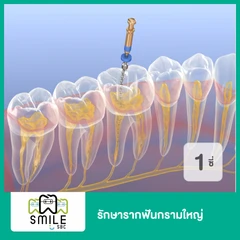 รักษารากฟัน กรามเล็ก หรือกรามใหญ่ 1 ซี่