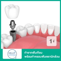 ทำรากฟันเทียม พร้อมทำครอบฟันเซรามิกล้วน สำหรับฟัน 1 ซี่