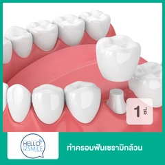 ทำครอบฟันเซรามิกล้วน สำหรับฟัน 1 ซี่