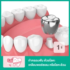 ทำครอบฟัน ด้วยโลหะเคลือบพอร์ซเลน หรือโลหะล้วน ขึ้นอยู่กับทันตแพทย์ประเมิน สำหรับฟัน 1 ซี่