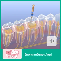 รักษารากฟันกรามใหญ่ 1 ซี่