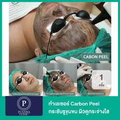 ทำเลเซอร์ Carbon Peel กระชับรูขุมขน ผิวดูกระจ่างใส 1 ครั้ง