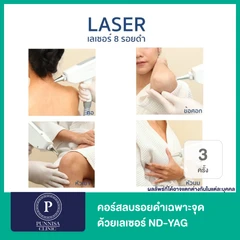 ลบรอยดำเฉพาะจุด ด้วยเลเซอร์ ND-YAG 1 จุด 3 ครั้ง