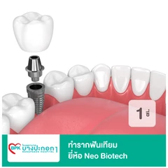 ทำรากฟันเทียม ยี่ห้อ Neo Biotech สำหรับฟัน 1 ซี่