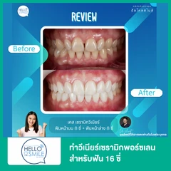 ทำวีเนียร์เซรามิกพอร์ซเลน สำหรับฟัน 16 ซี่