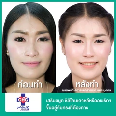 เสริมจมูก ซิลิโคนเกาหลีหรืออเมริกา ขึ้นอยู่กับทรงที่ต้องการ สำหรับผู้ที่เคยเสริมมาก่อน ที่ โรงพยาบาลจุฬารัตน์ 9 แอร์พอร์ต