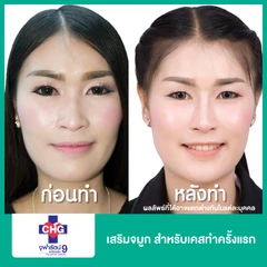 เสริมจมูก สำหรับเคสทำครั้งแรก