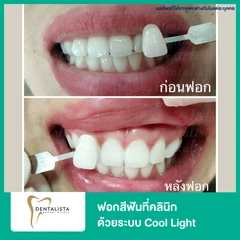 ฟอกสีฟันที่คลินิก ด้วยระบบ Cool Light