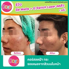 คอร์สลดฝ้า กระ รอยแผลจากสิวบนใบหน้า ด้วยเลเซอร์ Q-Switch ไม่จำกัดช็อต ขึ้นอยู่กับแพทย์ประเมิน + มาส์กหน้า เพิ่มความกระจ่างใส 3 ครั้ง