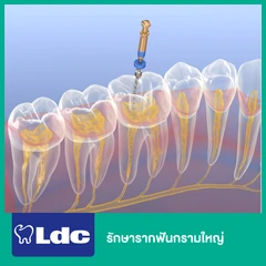 รักษารากฟันกรามใหญ่