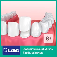 เคลือบผิวฟันและแปะฟันขาว ด้วยวีเนียร์เซรามิก 8 ซี่