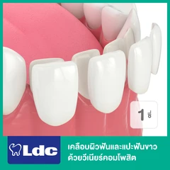 เคลือบผิวฟันและแปะฟันขาว ด้วยวีเนียร์คอมโพสิต 1 ซี่