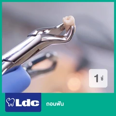 ถอนฟัน 1 ซี่