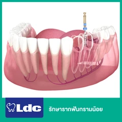 รักษารากฟันกรามน้อย