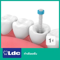 ทำเดือยฟัน 1 ซี่