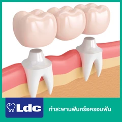 ทำสะพานฟันหรือครอบฟัน 1 ซี่