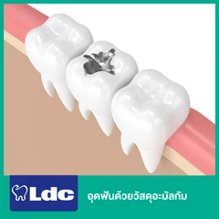 อุดฟันด้วยวัสดุอะมัลกัม