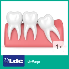 ผ่าฟันคุด 1 ซี่