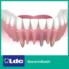 รักษารากฟันหน้า