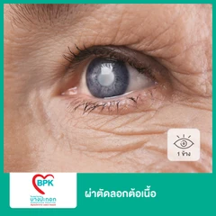 ผ่าตัดลอกต้อเนื้อ 1 ข้าง