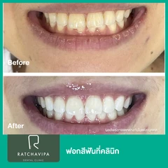 ฟอกสีฟันที่คลินิก ด้วยระบบ Zoom