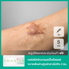 คอร์สฉีดรักษาแผลเป็นคีลอยด์ ขนาดเส้นผ่านศูนย์กลางไม่เกิน 3 ซม. 5 ครั้ง
