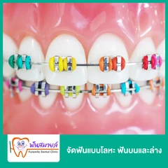 จัดฟันแบบโลหะ ฟันบนและล่าง